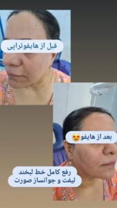 نمونه کار هایفوتراپی (کلینیک لاغری طراوت)