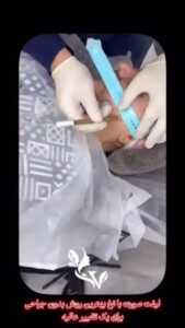 نمونه کار لیفت با نخ (دکتر سیاوش وکیلی)