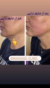 نمونه کار هایفوتراپی (کلینیک لاغری طراوت)