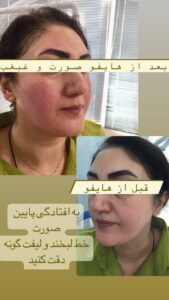 نمونه کار هایفوتراپی (کلینیک لاغری طراوت)