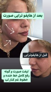 نمونه کار هایفوتراپی (کلینیک لاغری طراوت)