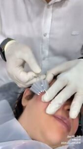 نمونه کار لیفت با نخ (دکتر سیاوش وکیلی)