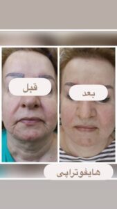 نمونه کار هایفوتراپی (کلینیک لاغری طراوت)