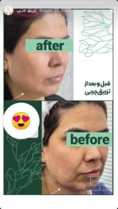 نمونه کار تزریق چربی دکتر زهرا خانی در مشهد