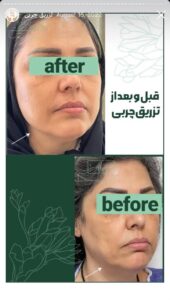 نمونه کار تزریق چربی دکتر زهرا خانی در مشهد
