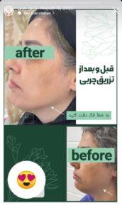 نمونه کار تزریق چربی دکتر زهرا خانی در مشهد