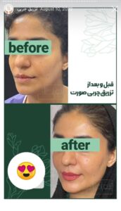 نمونه کار تزریق چربی دکتر زهرا خانی در مشهد
