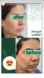نمونه کار تزریق چربی دکتر زهرا خانی در مشهد