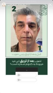 نمونه کار تزریق چربی دکتر زهرا خانی در مشهد