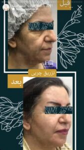 نمونه کار تزریق چربی دکتر زهرا خانی در مشهد