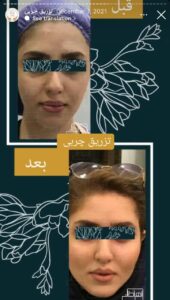 نمونه کار تزریق چربی دکتر زهرا خانی در مشهد