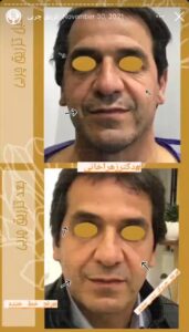 نمونه کار تزریق چربی دکتر زهرا خانی در مشهد