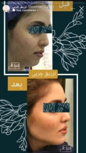 نمونه کار تزریق چربی دکتر زهرا خانی در مشهد