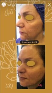 نمونه کار تزریق چربی دکتر زهرا خانی در مشهد