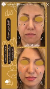 نمونه کار تزریق چربی دکتر زهرا خانی در مشهد