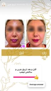 نمونه کار تزریق چربی دکتر زهرا خانی در مشهد