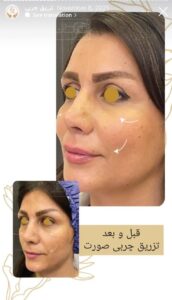نمونه کار تزریق چربی دکتر زهرا خانی در مشهد
