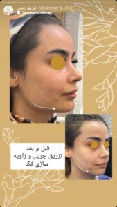 نمونه کار تزریق چربی دکتر زهرا خانی در مشهد