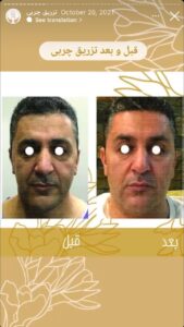 نمونه کار تزریق چربی دکتر زهرا خانی در مشهد