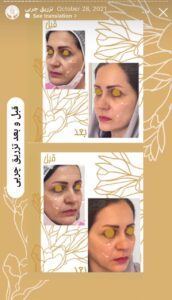نمونه کار تزریق چربی دکتر زهرا خانی در مشهد