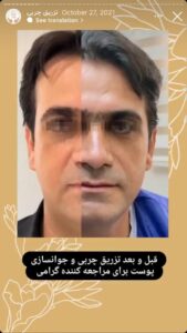 نمونه کار تزریق چربی دکتر زهرا خانی در مشهد