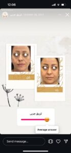 نمونه کار تزریق چربی دکتر زهرا خانی در مشهد