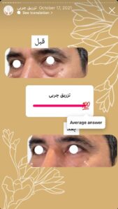 نمونه کار تزریق چربی دکتر زهرا خانی در مشهد
