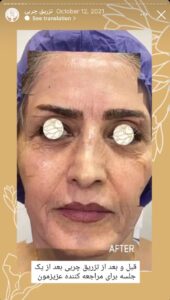 نمونه کار تزریق چربی دکتر زهرا خانی در مشهد