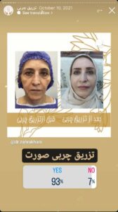 نمونه کار تزریق چربی دکتر زهرا خانی در مشهد