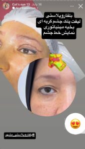 نمونه جراحی پلک دکتر نسرین تحویلدار نژاد در مشهد