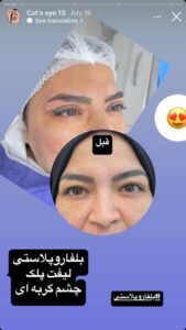 نمونه جراحی پلک دکتر نسرین تحویلدار نژاد در مشهد