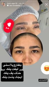 نمونه جراحی پلک دکتر نسرین تحویلدار نژاد در مشهد