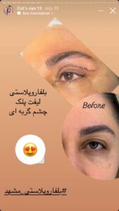 نمونه جراحی پلک دکتر نسرین تحویلدار نژاد در مشهد