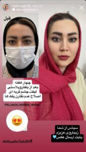 نمونه جراحی پلک دکتر نسرین تحویلدار نژاد در مشهد