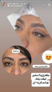 نمونه جراحی پلک دکتر نسرین تحویلدار نژاد در مشهد