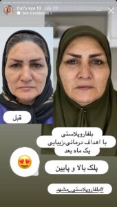 نمونه جراحی پلک دکتر نسرین تحویلدار نژاد در مشهد