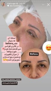 نمونه جراحی پلک دکتر نسرین تحویلدار نژاد در مشهد
