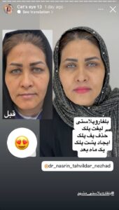 نمونه جراحی پلک دکتر نسرین تحویلدار نژاد در مشهد