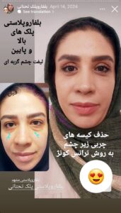 نمونه جراحی پلک دکتر نسرین تحویلدار نژاد در مشهد