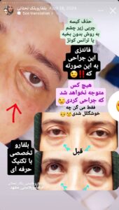 نمونه جراحی پلک دکتر نسرین تحویلدار نژاد در مشهد