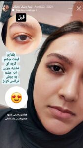 نمونه جراحی پلک دکتر نسرین تحویلدار نژاد در مشهد