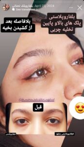 نمونه جراحی پلک دکتر نسرین تحویلدار نژاد در مشهد