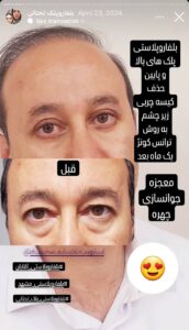 نمونه جراحی پلک دکتر نسرین تحویلدار نژاد در مشهد