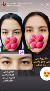 نمونه جراحی پلک دکتر نسرین تحویلدار نژاد در مشهد
