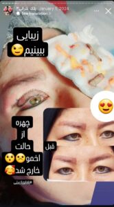 نمونه جراحی پلک دکتر نسرین تحویلدار نژاد در مشهد