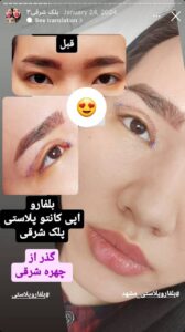 نمونه جراحی پلک دکتر نسرین تحویلدار نژاد در مشهد