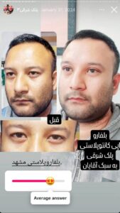 نمونه جراحی پلک دکتر نسرین تحویلدار نژاد در مشهد