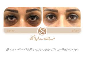 نمونه کار جراحی پلک کلینیک سلامت ایده آل در مشهد