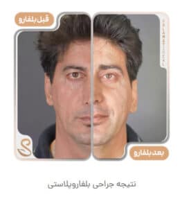 نمونه کار جراحی پلک کلینیک سلامت ایده آل در مشهد