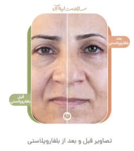 نمونه کار جراحی پلک کلینیک سلامت ایده آل در مشهد